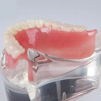 Dental Dentes Estudo Ensinar Modelo De Overdenture Inferior A 4 Implantes Modelo De Demonstração